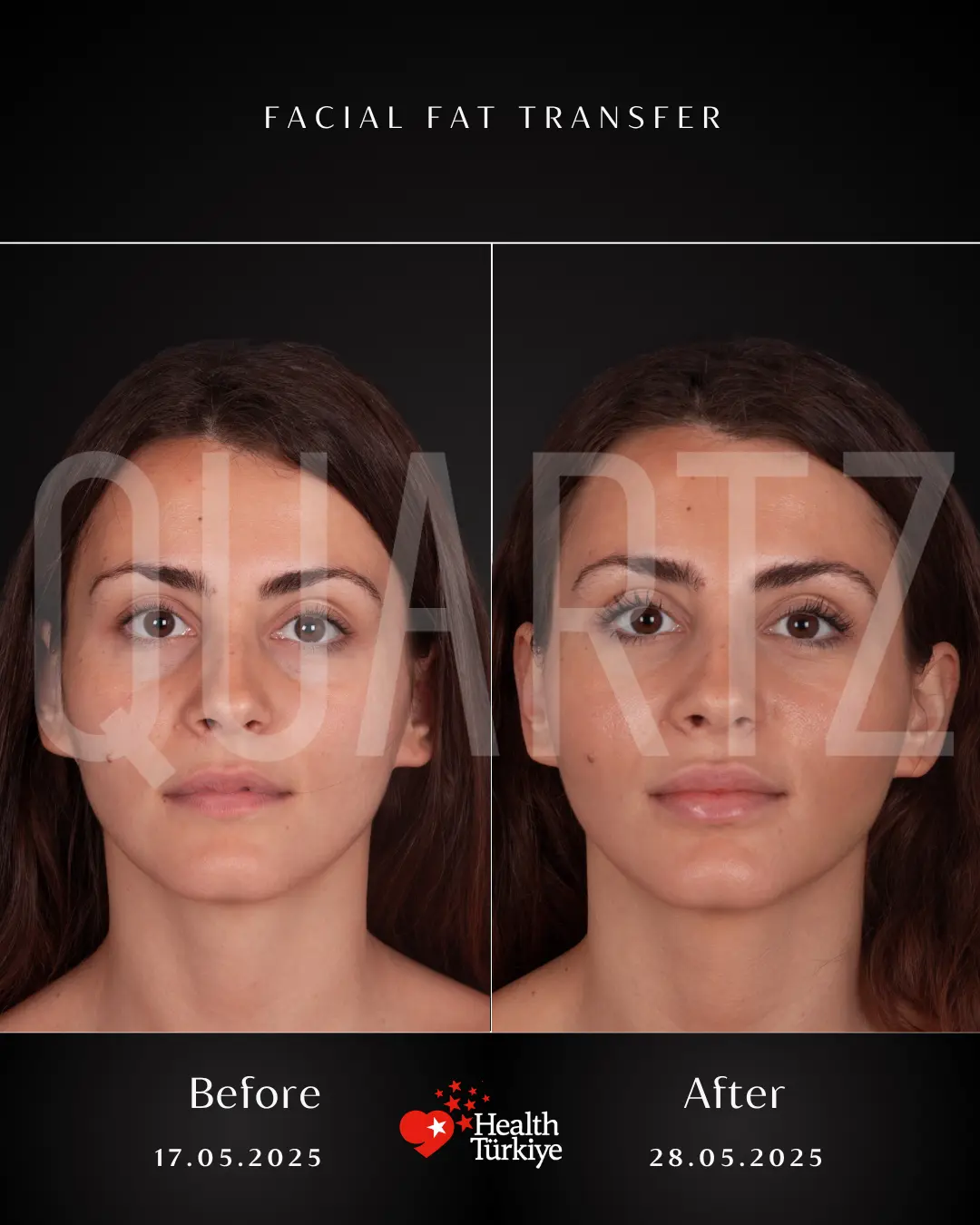 Before & After: Facial Fat Transfer New Result 1
